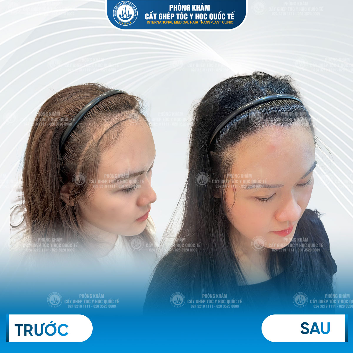 kết quả sau cấy tóc 