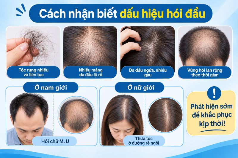 cách nhận biết dấu hiệu hói đầu 
