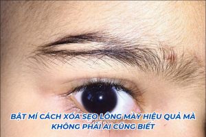 cách xoá sẹo lông mày
