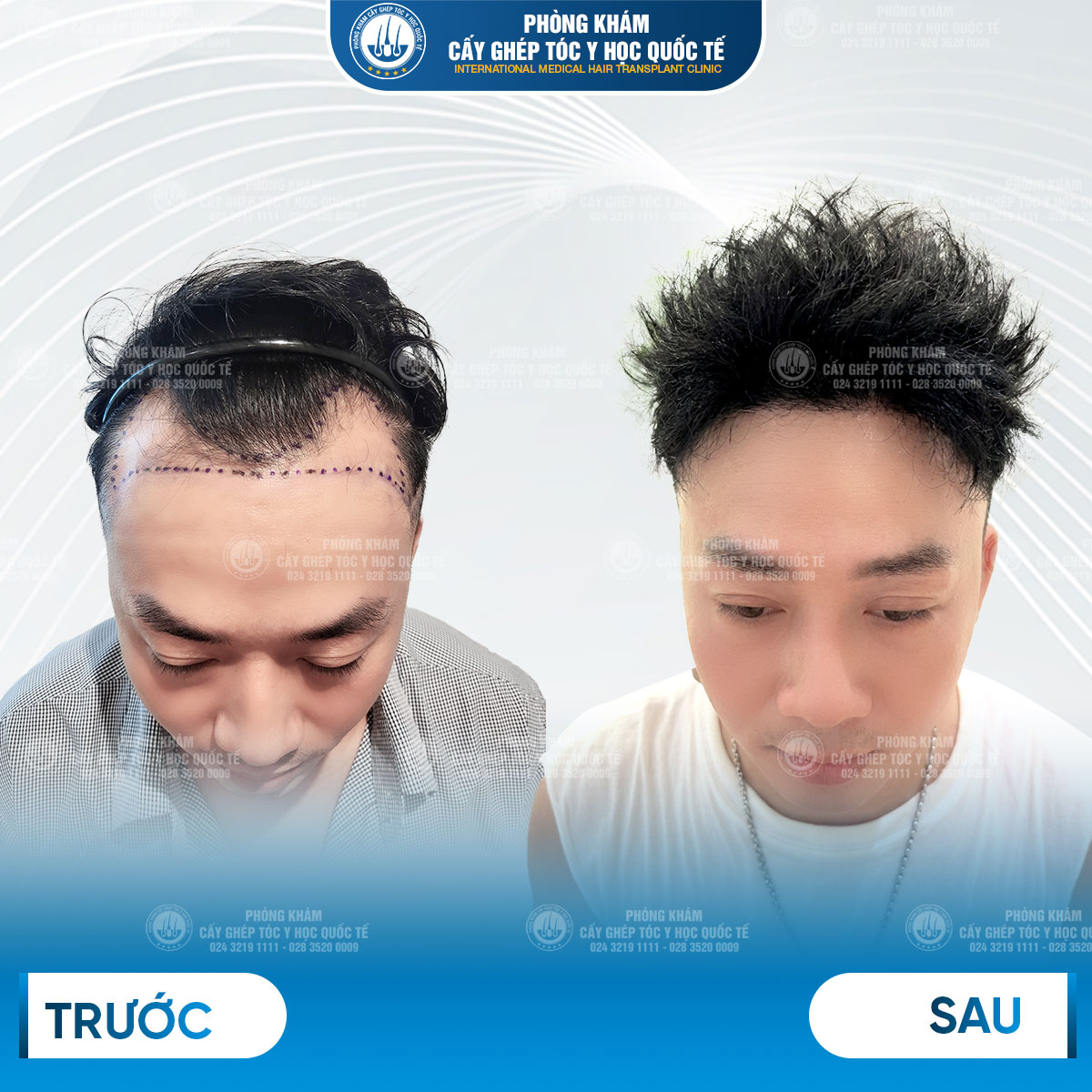 hiệu quả cấy tóc tự thân 
