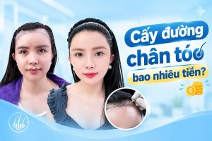 cấy đường chân tóc trán bao nhiêu tiền