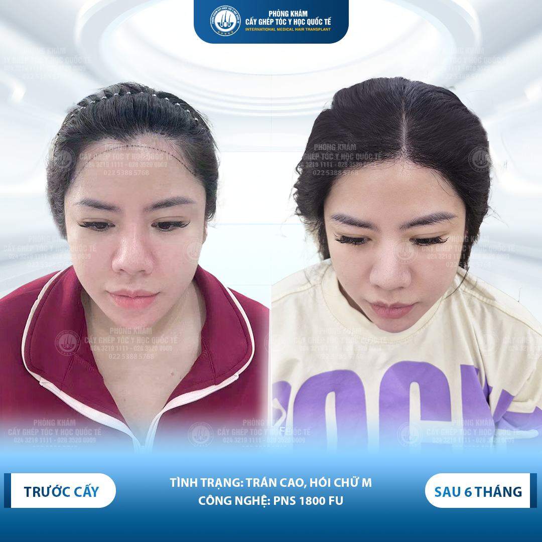 cấy tóc có hiệu quả không