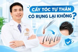 cấy tóc rụng lại không