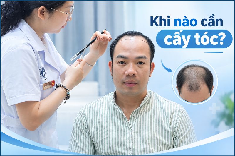 Khi nào cần cấy tóc