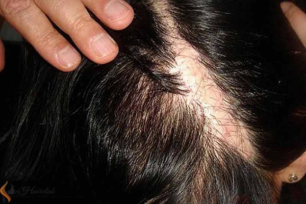 cấy tóc trên sẹo là gì 