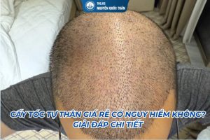 cấy tóc tự thân có nguy hiểm khogn
