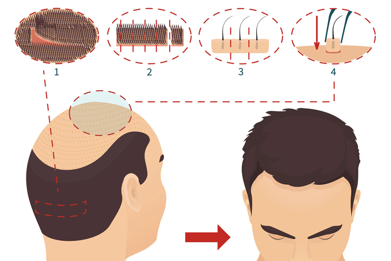cấy tóc tư thân là gì