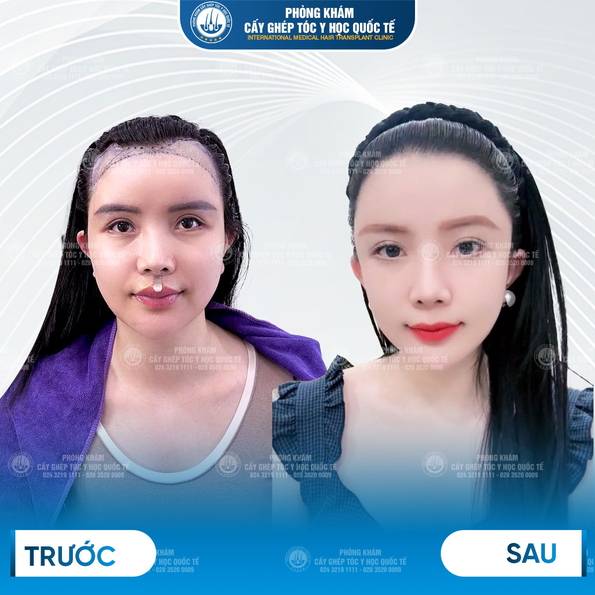 cấy tóc vùng trán cao 