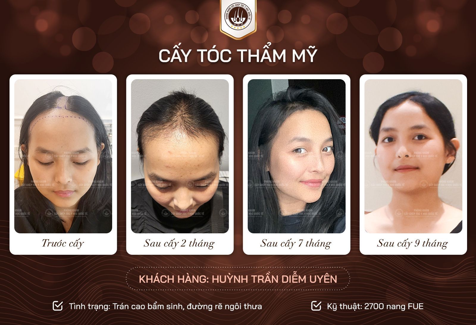 chu trình mọc tóc sau cấy 