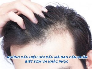 dấu hiệu nhận biết hói đầu sớm