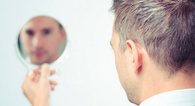 hói đầu bẩm sinh nguyên nhân do đâu 