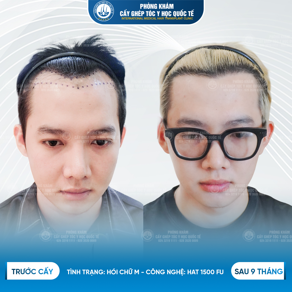 kết quả cấy ghép tóc tại y học quốc tế 