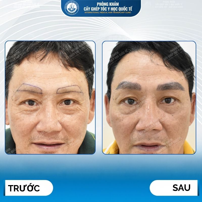 hiệu quả cấy lông mày trên sẹo 