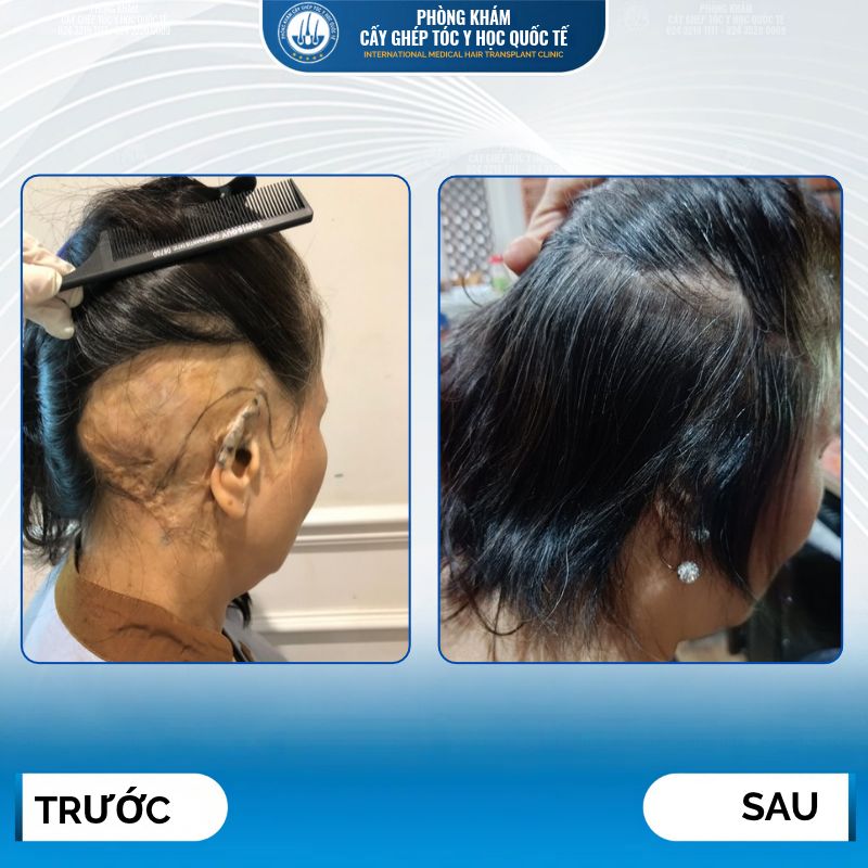 kết quả cấy tóc trên sẹo 