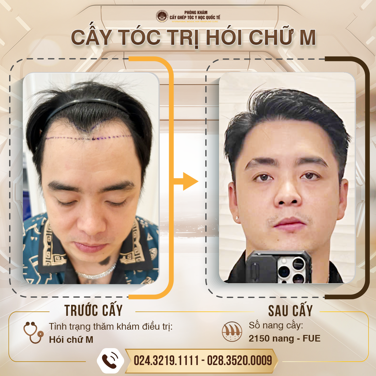 kết quả cấy tóc tại phòng khám