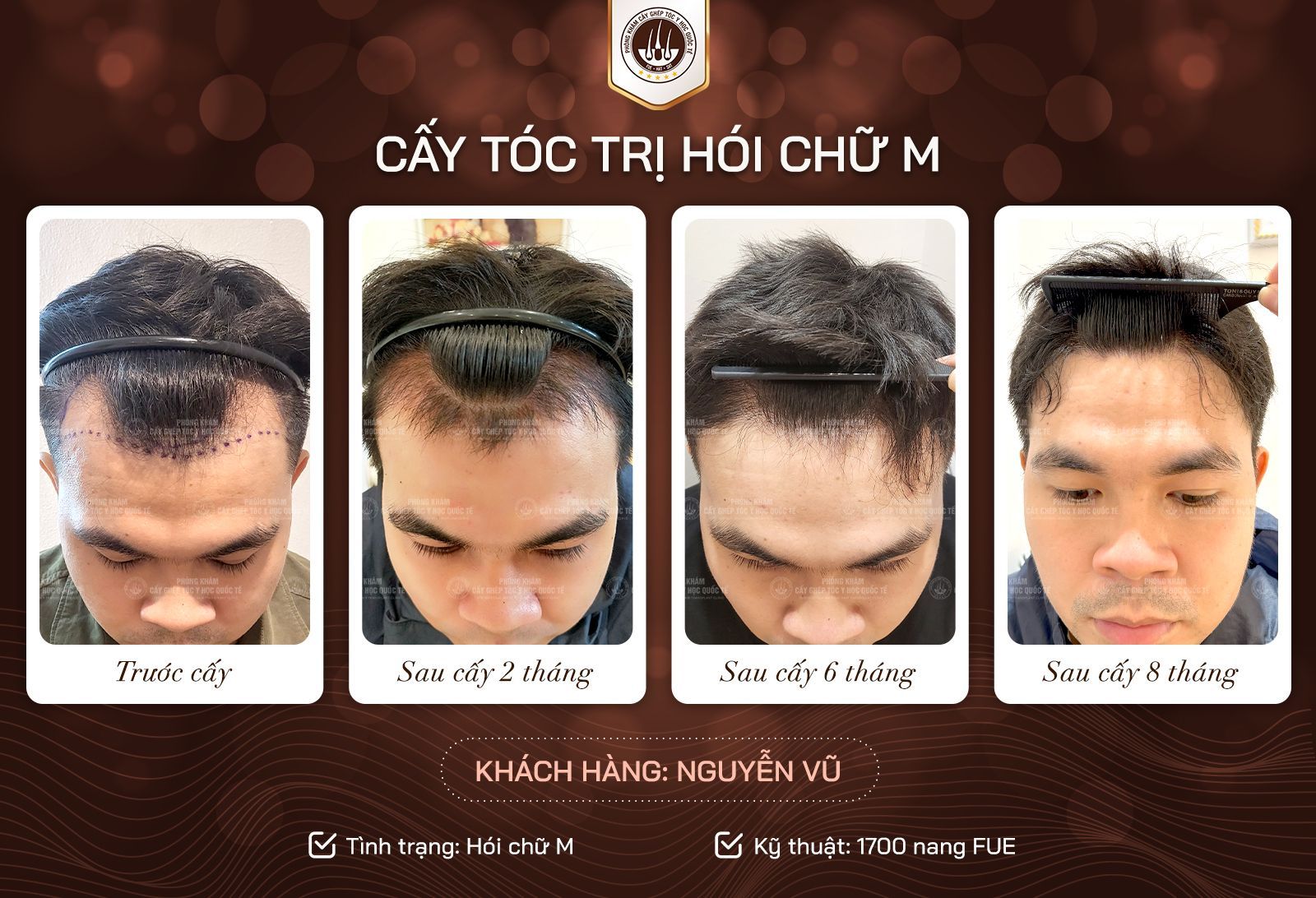 kết quả sau cấy phụ thuôc vào