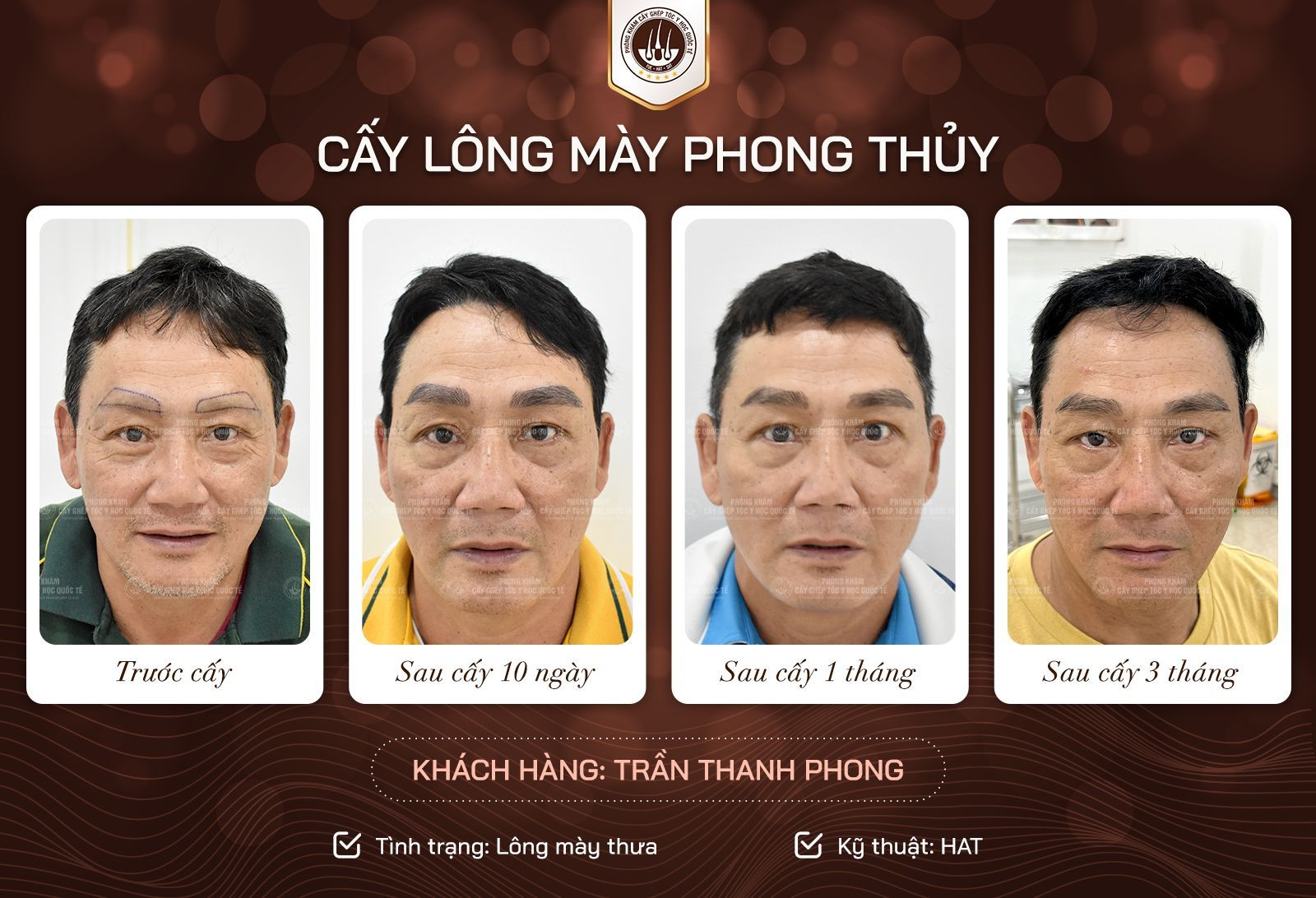 kết quả sau cấy lông mày 