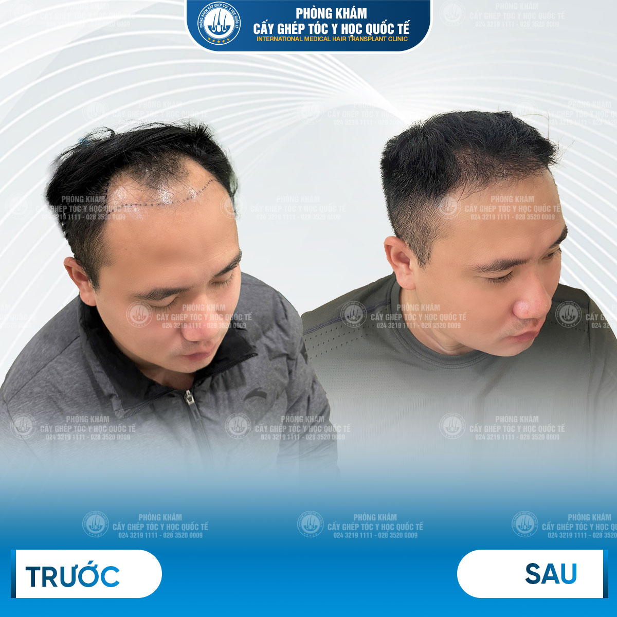 kết quả sau cấy tóc 