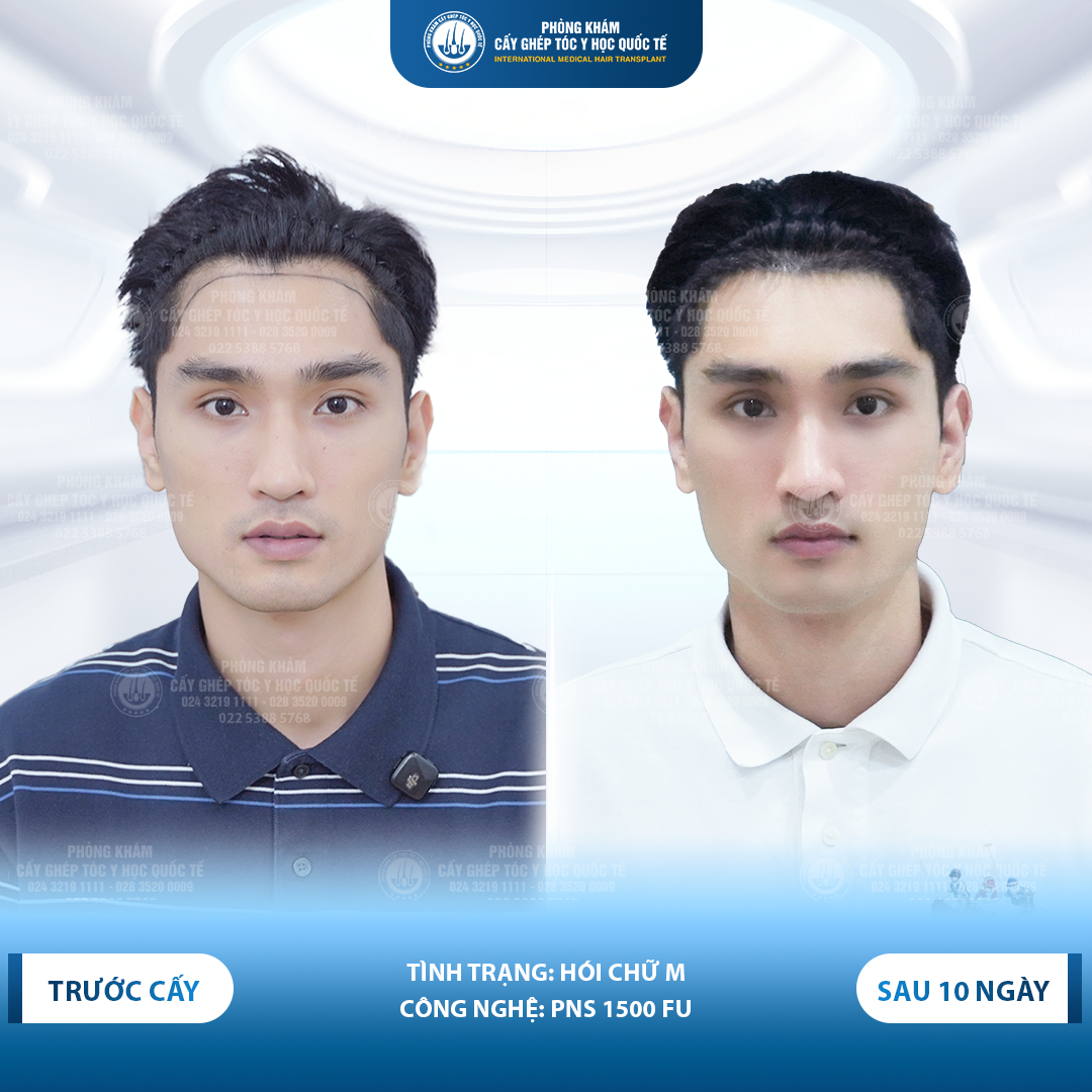 Cách trị rụng tóc hói đầu dứt điểm bằng cấy tóc tự thân