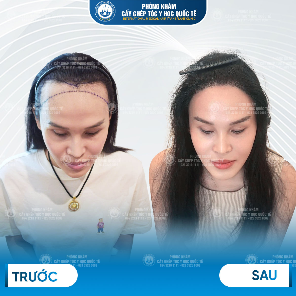 kết quả cấy tại Viện cấy tóc y học quốc tế 