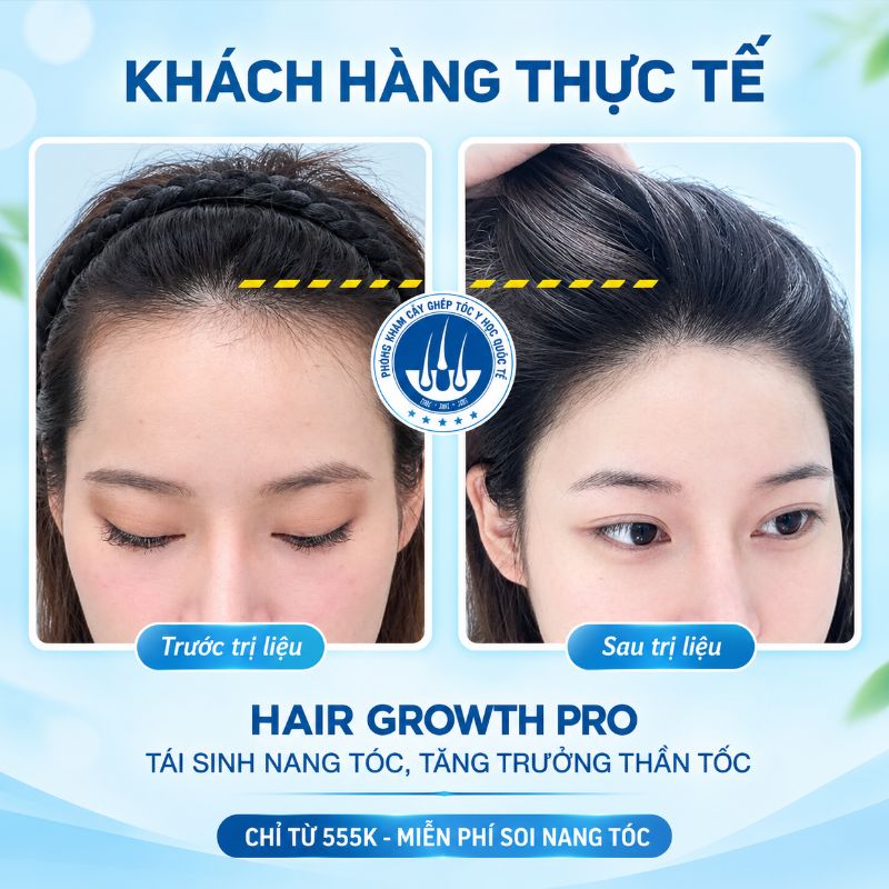 Hair Growth Pro - phương pháp trị rụng tóc nữ hiệu quả