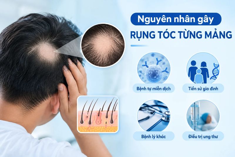 nguyên nhân rụng tóc từng mảng 