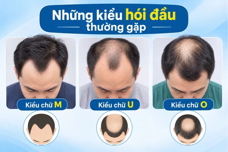 những kiểu hói đầu thường gặp 