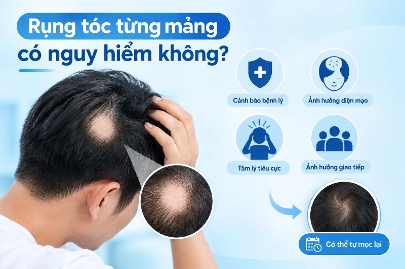 Rụng tóc từng mảng có nguy hiểm không?