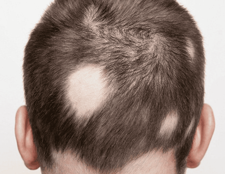 rụng tóc từng mảng là gì 