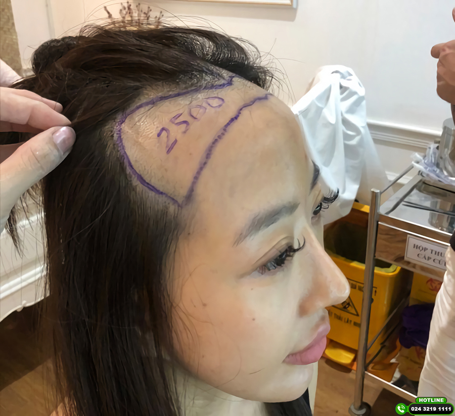 tình trạng thực tế và số nang cần cấy 
