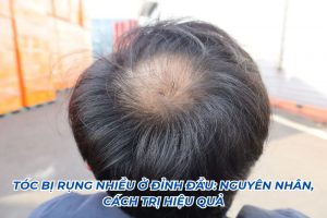 tóc bị rụng nhiều ở đỉnh đầu