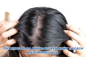tóc rụng do da nhờn