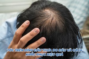 tóc trên đỉnh đầu thưa do đâu
