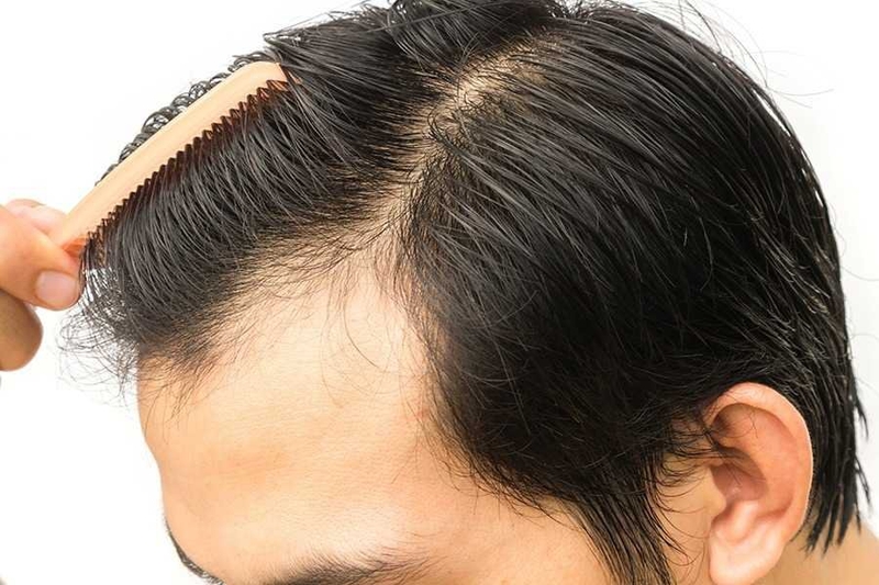 tránh tác động lên vùng cấy tóc 