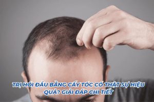 trị hói đầu bằng cấy tóc có thực sự hiệu quả